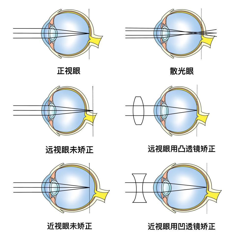 屈光不正的眼球.png